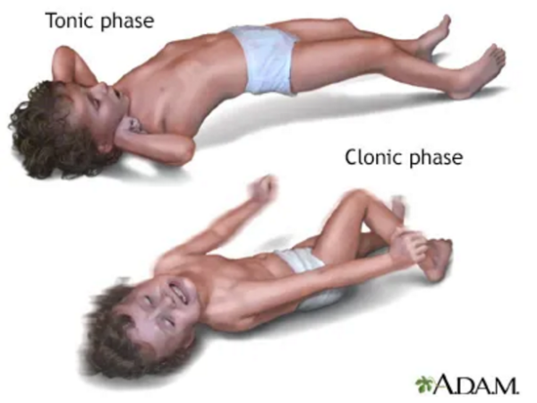 醫學探案之發熱抽搐是什么原因