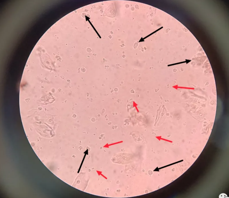 婦科感染中的極特殊情況了解下！